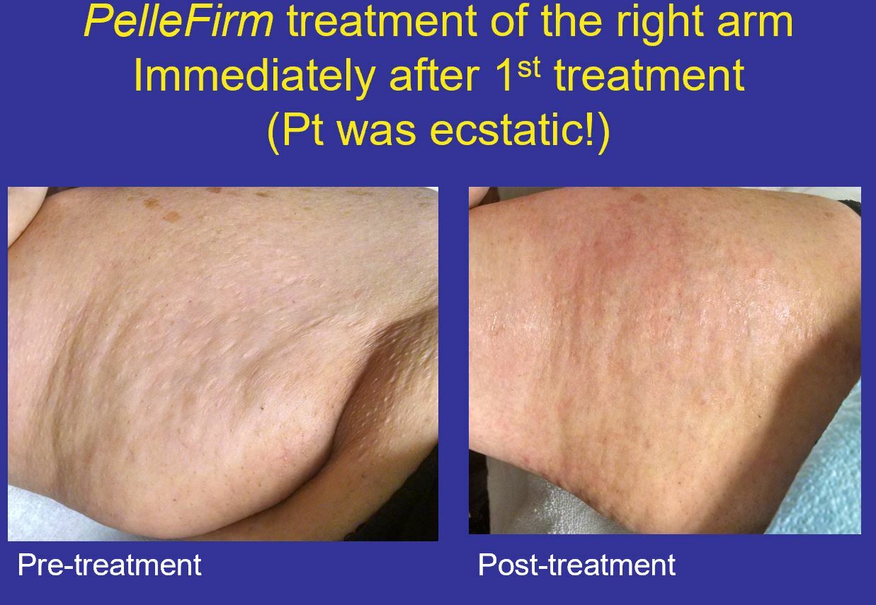 25mm PelleFirm Skin Tightening Handpiece by Ellman