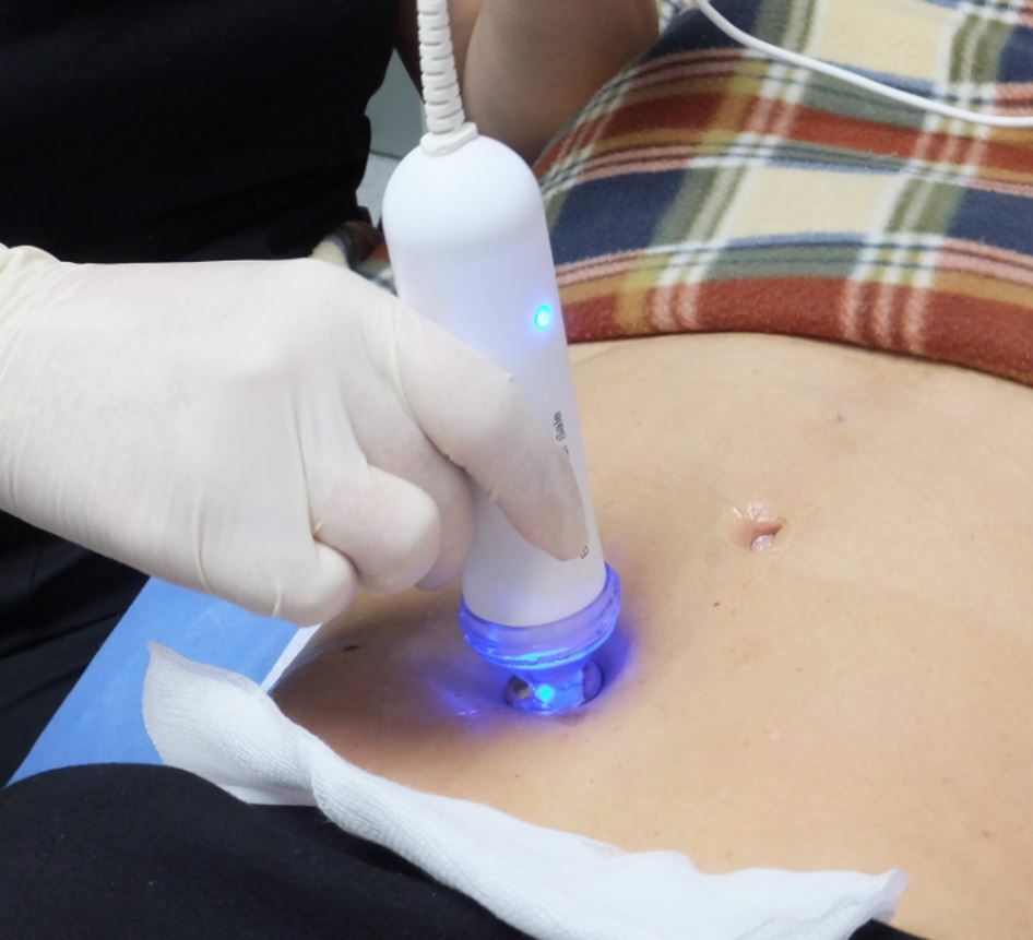 25mm PelleFirm Skin Tightening Handpiece by Ellman