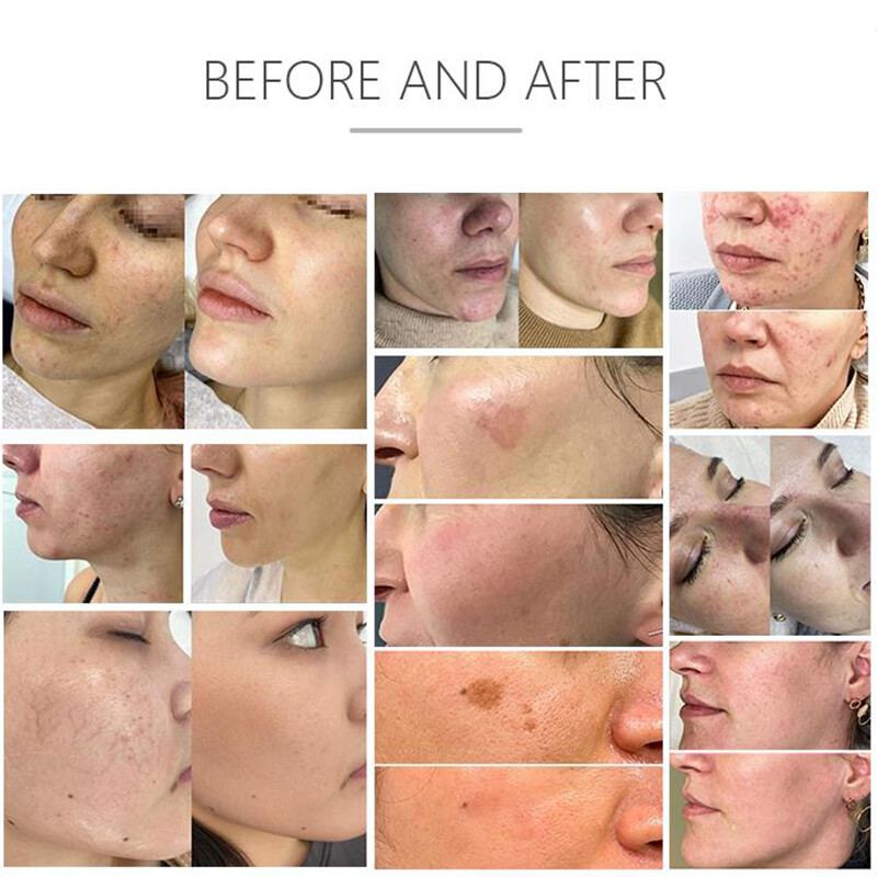 M22 IPL S-H-R OPT Laser Hair Removal Machine For Skin Whitening Anti-Aging Acne