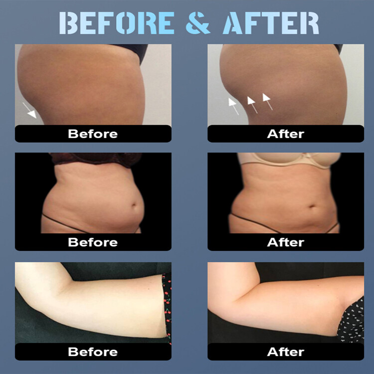 Body Slimming Fat Reduce Roller Machine Endos Lymphatic Drainage Muscle Massage