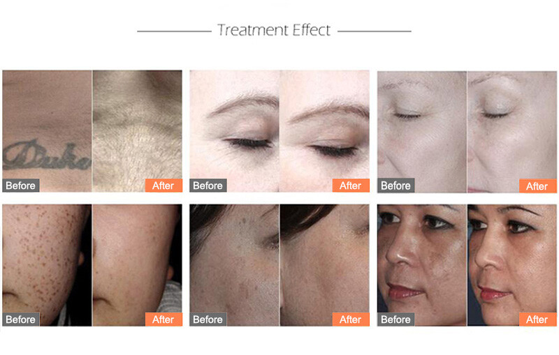 Picolaser picosecond laser tattoo birth mark removal beauty machine carbon peel