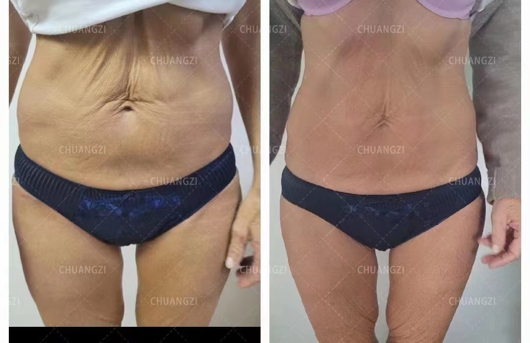 2025 TAIXL Body Shaping Massage Fat Removal Body Sculpt Build Muscles Machine