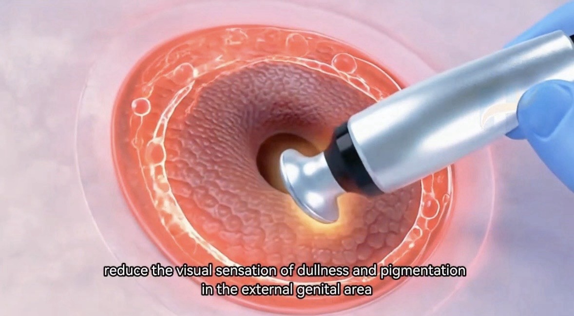Professional 6-in-1 Vaginal Rejuvenation RF Therapy Machine Home & Salon Use