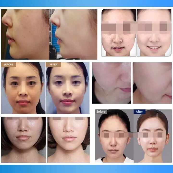 Mesogun Facial Skin Lifting Wrinkle Removal Machine Mesotherapy SPA Anti-Aging