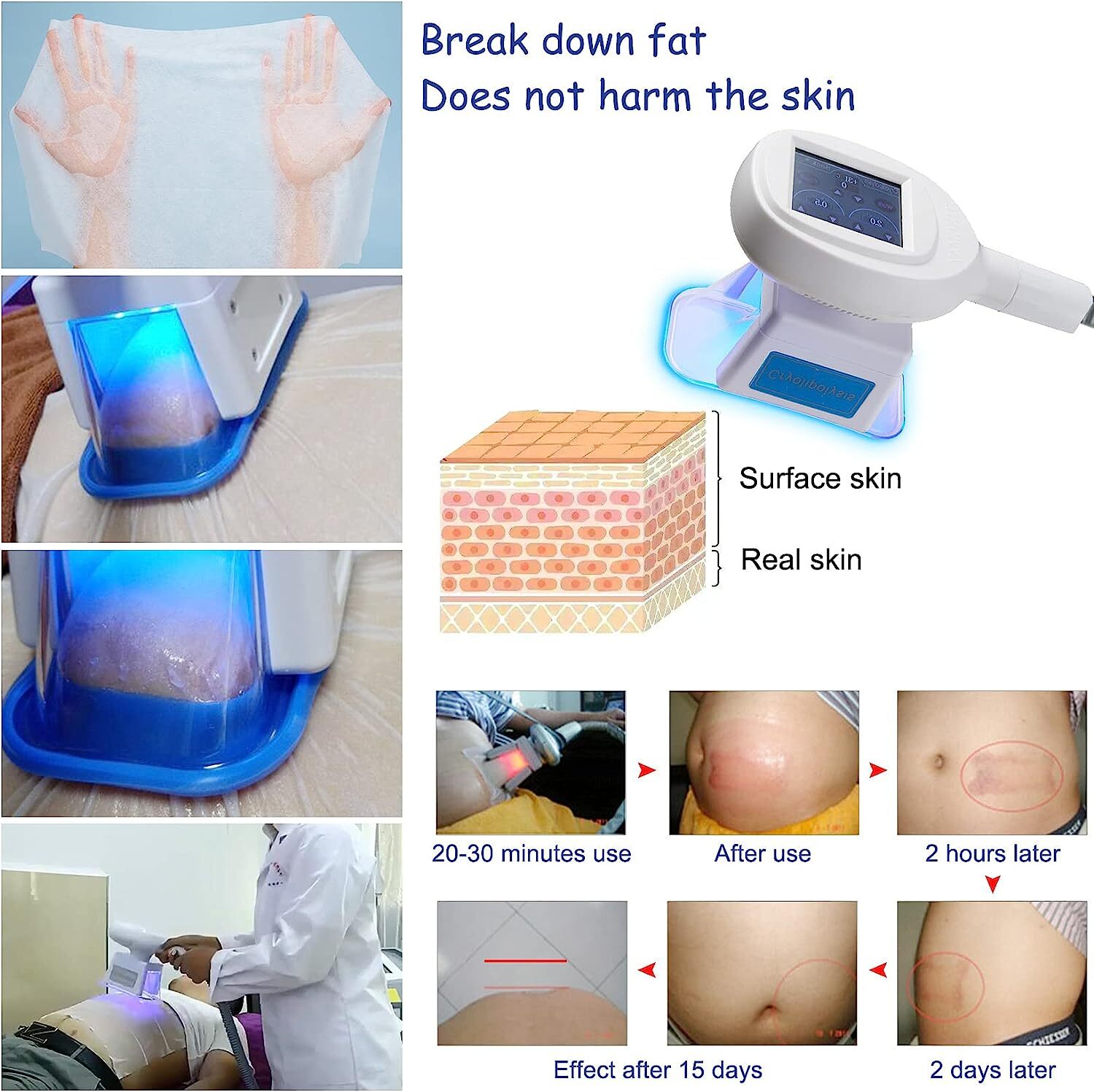 Body Sculpting Cryo therapy Fat Freezing Machine Loss Weight Skin Tightening