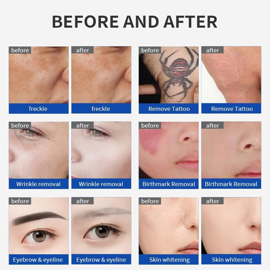 Professional Picosecond Laser for Tattoo Removal Skin Rejuvenation Resurfacing