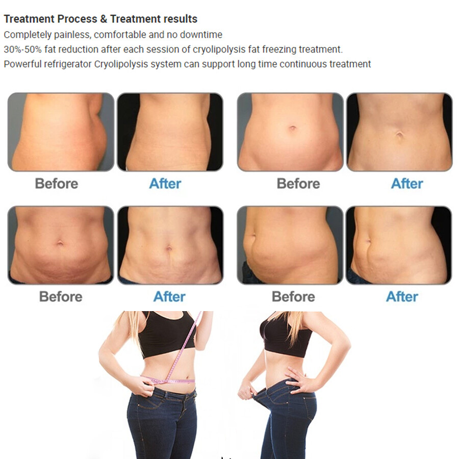 Professional Cryo Body Slimming Machine Fat Freezing Shaping Vacuum Skin Lifting