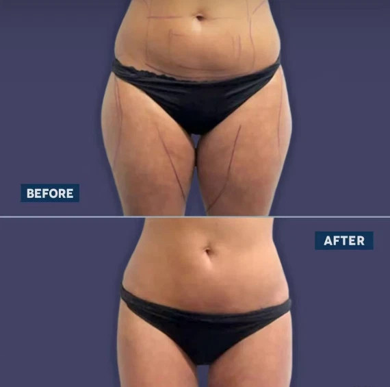 2026 Endolift Laser Body Shaping Machine for Fat Ablation and Skin Rejuvenation