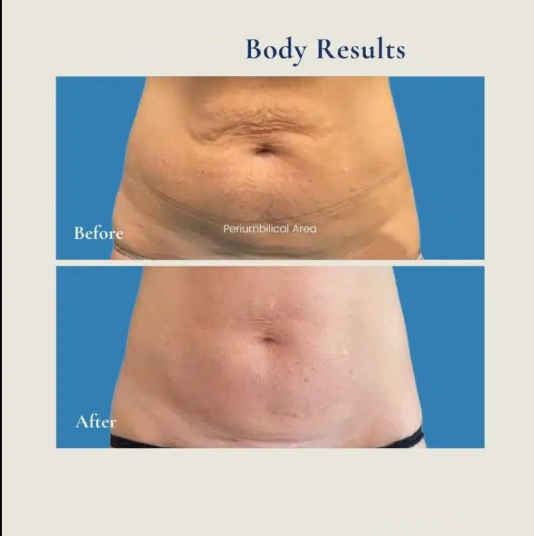 1470+980 Fat Dissolving Machine, Thigh and Hip Fat Removal Machine Coolsculpting