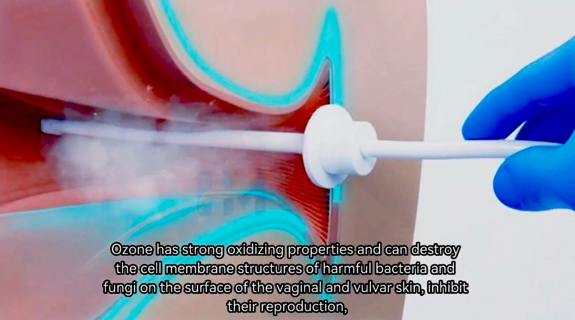 Professional 6-in-1 Vaginal Rejuvenation RF Therapy Machine Home & Salon Use