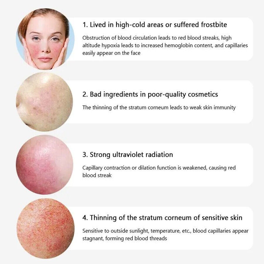 980nm Diode Laser Skin Rejuvenation Machine Spider Veins Facial Redness Reduce