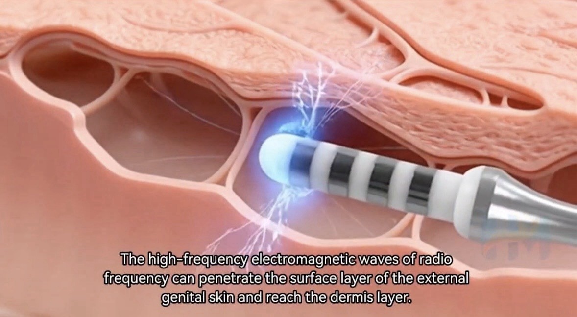 Professional 6-in-1 Vaginal Rejuvenation RF Therapy Machine Home & Salon Use