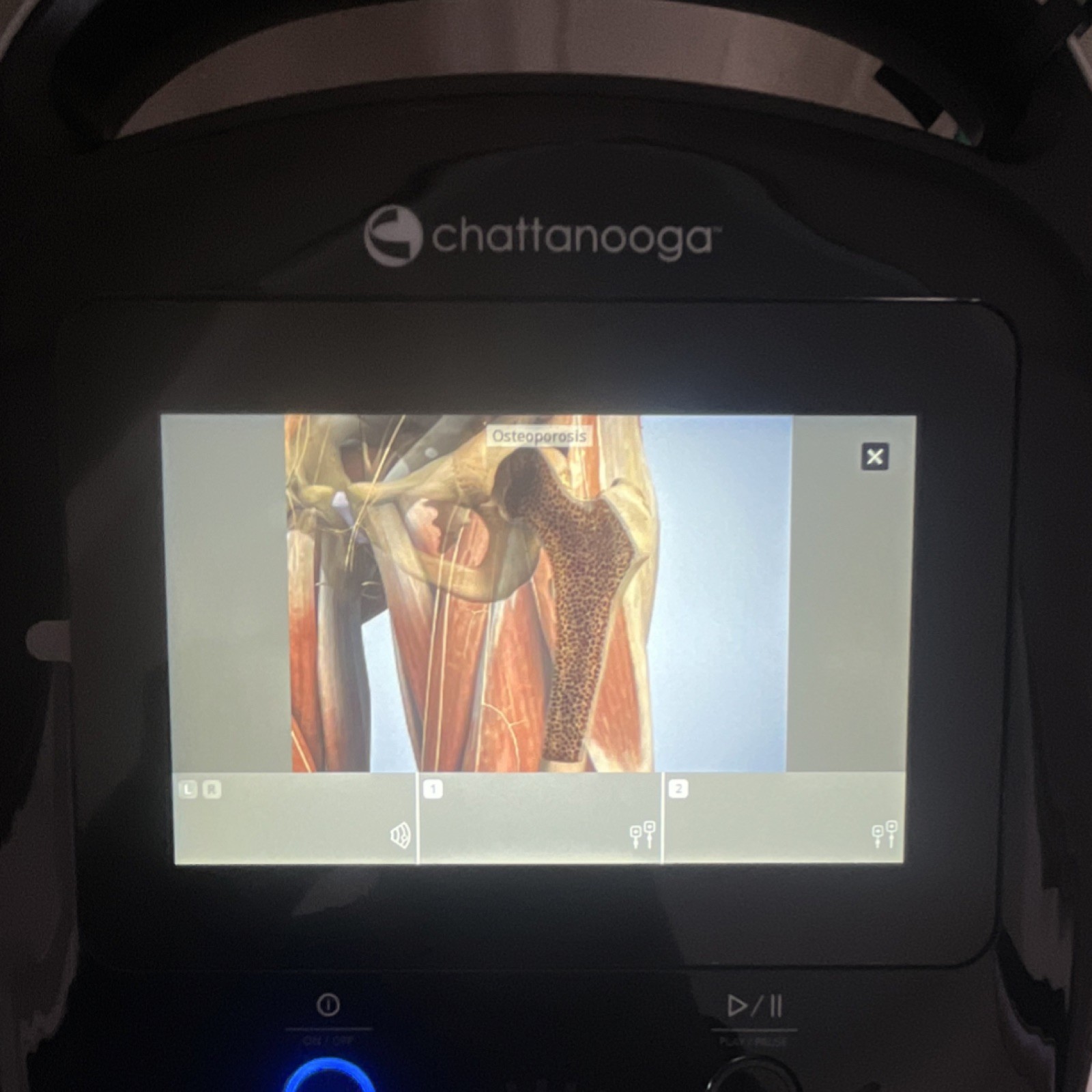 Chattanooga Intellect Legend 2 w/Cart. Touchscreen Ultrasound / E Stim System