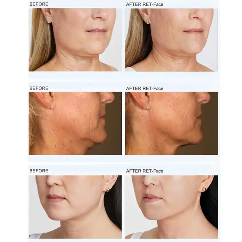FACE Vline Face Lifting Skin Care Wrinkle Removal Machine EMT EMS Facial Contour