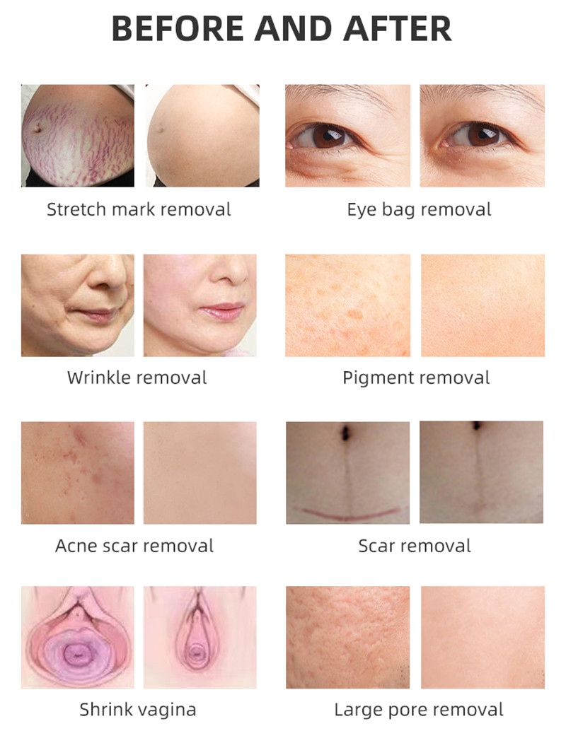 Skin Repair Laser Co2 Fractional Device Wrinkle Scar Removal Tightening