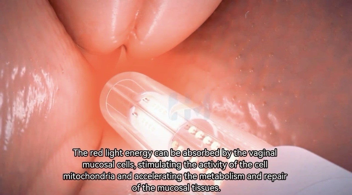 Professional 6-in-1 Vaginal Rejuvenation RF Therapy Machine Home & Salon Use