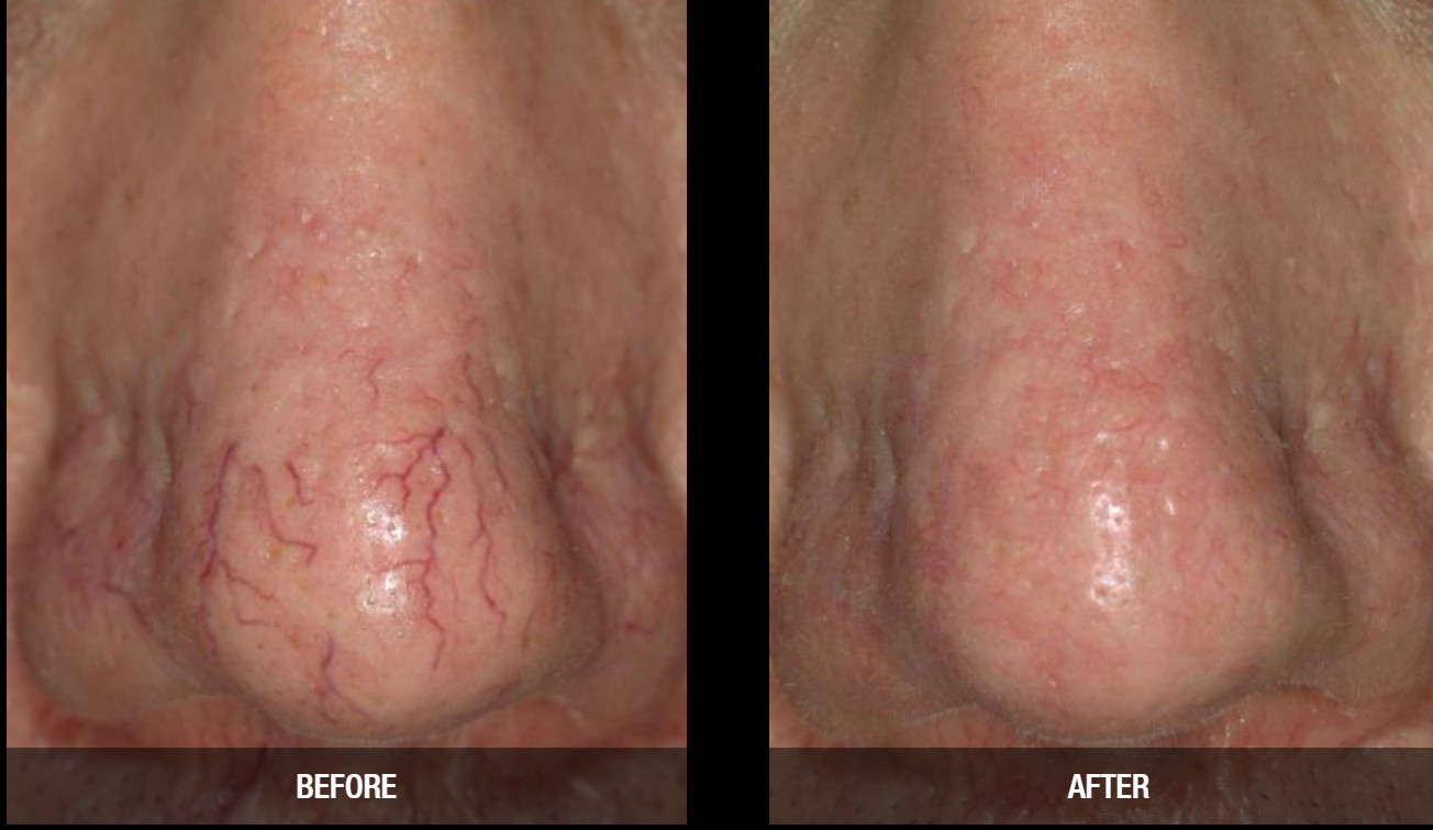 ✅Syneron Candela Pro Series HP Compatible For Gentle Pro Series GentleMax Pro