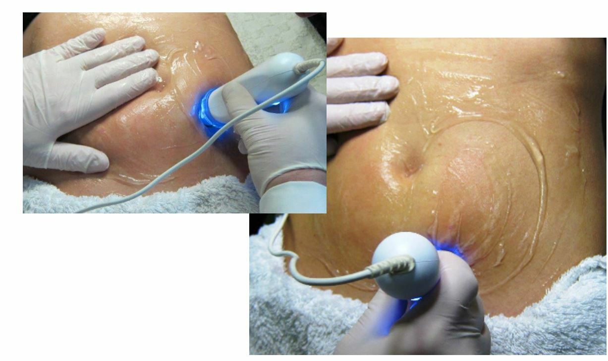 25mm PelleFirm Skin Tightening Handpiece by Ellman
