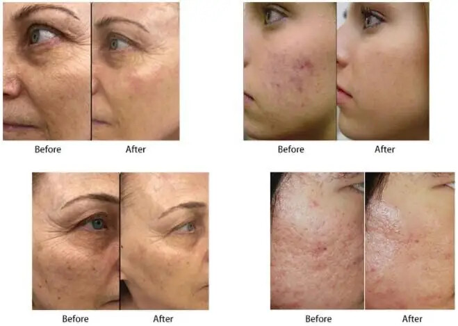 Morpheus8 Fractional Gold Radio Frequency Facial Lifting Skin Tightening Machine